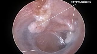 Otoendoscopy  Naturally healed central perforation of eardrum with Tympanosclerosis [upl. by Ikkim76]