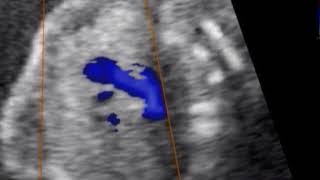 Hipoplasia de ventrículo izquierdo en gestante de 19 semanas con antecedente de TN aumentada [upl. by Rumpf]