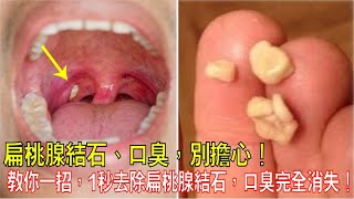 扁桃腺結石、口臭，別擔心！教你一招，1秒去除扁桃腺結石，口臭完全消失了！口腔清潔、衛生、無異味！ [upl. by Enuj170]