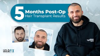 5 Months PostOp Hair Transplant Results  Hairfix México [upl. by Etnoval]