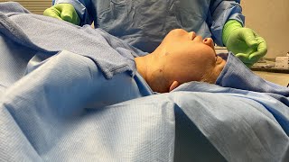 Liposuction of the neck plus skin tightening and fat transfer [upl. by Asillam]