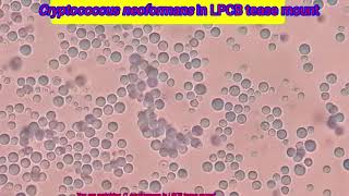 Cryptococcus neoformans in LPCB tease mount [upl. by Tillfourd]