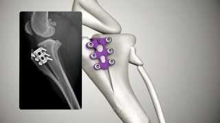 Tibial Tuberosity Advancement TTA RAPID [upl. by Eilhsa39]