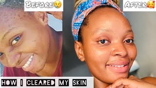 How to get rid of dark spots and pimplesclear skincare routine gentle magicSouth African youtuber [upl. by Eeresid]