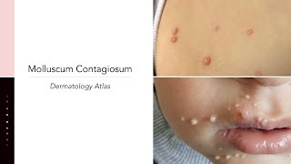 Molluscum Contagiosum [upl. by Aliek]