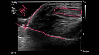 Ultrasound guided knee joint injection [upl. by Sadoff]