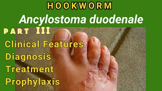 Hookworm  Ancylostomiasis Clinical Features Diagnosis Treatment Prophylaxis  AM Biologie Notes [upl. by Nonohcle]