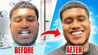 Is it a GOOD IDEA to get your teeth done in TURKEY TEETH TRANSFORMATION [upl. by Cheyney475]