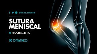 SUTURA MENISCAL [upl. by Aharon524]