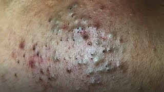 Clear Nose Blackheads  ASMR [upl. by Leuams827]