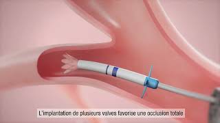 La valve endobronchique Zephyr® pour les personnes atteintes de BPCO et demphysème Français [upl. by Sherburn]