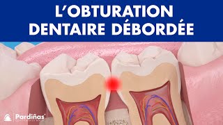 Problèmes de plombage dent – L’obturation dentaire débordée © [upl. by Heringer]