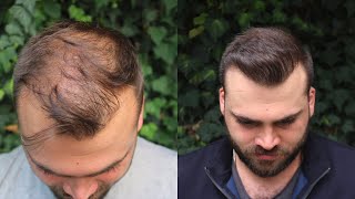 Hair Transplant Result with 3040 Grafts  EXTREME TRANSFORMATION from 0 days to 10 Months [upl. by Dagna]