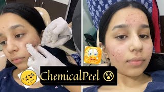 My First Chemical Peel Treatment For Acne  My Experience Of 7 Days with Pictures [upl. by Elynad]