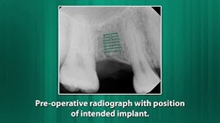 TwoStage Implant Placement for a Congenitally Missing Maxillary Premolar [upl. by Anyah]