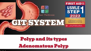 USMLE Step1 Polyp and its types Adenomatous Polyps from first aid step 1USMLEUrduHindi [upl. by Amery442]