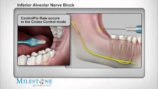 Inferior Alveolar Nerve Block [upl. by Aruat799]