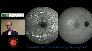 Central Serous Chorioretinopathy [upl. by Jeanna]