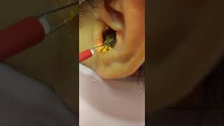 Ear wax removal large chunk [upl. by Ecirtal]