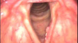 Carcinoma in Situ Larynx [upl. by Kurtz]