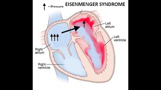 Patent Foramen Ovale Atrial Septal Defect amp Eisenmenger syndrome amp Paradoxical embolism [upl. by Croft]