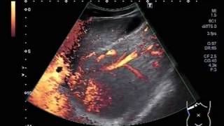 Ultrasound Video showing Hepatic parenchymal disease in a young patient of about 23 years [upl. by Azal]