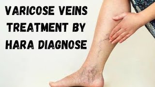 Varicose Veins Treatment by Hara Diagnose  9463086527  Gurnam Singh [upl. by Shiff774]