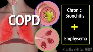 COPD  Chronic Obstructive Pulmonary Disease Animation [upl. by Anale]