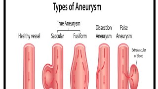 Aneurysm heart diseasesdisorders series MSN topic Theaiims01 [upl. by Chow]