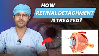 How Retinal Detachment Treated  Retinal Detachment Signs Symptoms amp Treatments [upl. by Ramberg]