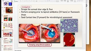 Bacterial Keratitis Part 2 [upl. by Hole]