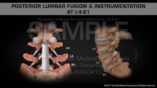 Posterior Lumbar Fusion amp Instrumentation at L4S1 [upl. by Hamnet]