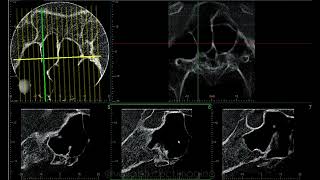 SPHENOID SINUS CASE REPORT [upl. by Lizzie459]