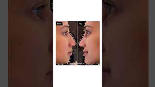 NonSurgical Nose and Chin Contouring [upl. by Gipsy969]