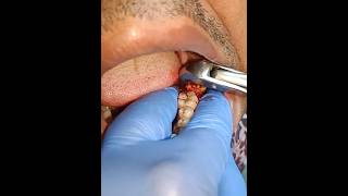 2nd Molar Tooth extraction 37 [upl. by Armyn]