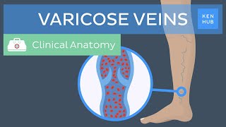 Varicose veins Definition causes symptoms and treatment  Kenhub [upl. by Atinwahs]