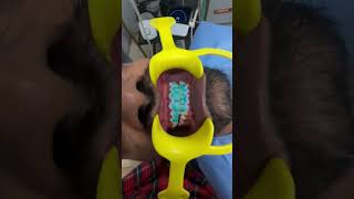 Dental Bleaching case🤍🫶🏻🤍reel reels reelsinstagram instagram reelitfeelit trending love vira [upl. by Eldred12]