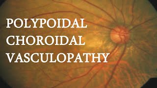 OCT in PACHYCHOROIDAL VASCULOPATHY [upl. by Attecnoc]