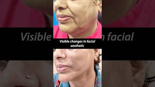 Facelift with Permanent Infinite Thread  NonSurgical Scarless Result shortsfeed [upl. by Jehias]