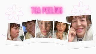 TCA peeling ile yüzümü soydum  Kimyasal peeling [upl. by Bohner]