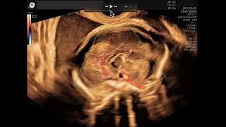 Embarazo de 24 semanas Agenesia parcial de cuerpo calloso [upl. by Ilellan]