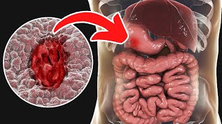 Symptoms causes and treatments of stomach ulcers YOU MUST KNOW [upl. by Isied]