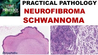 NEUROFIBROMA AND SCHWANNOMA Clinical features amp Morphology [upl. by Jeaz848]