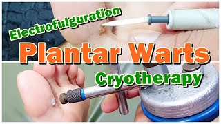 How to Treat Plantar Warts with Electrofulguration and Cryotherapy  Viral Warts  Electric Cautery [upl. by Annaili]