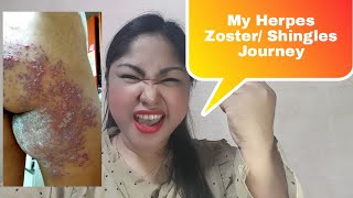 MY HERPES ZOSTER  SHINGLES JOURNEY English [upl. by Aicel]