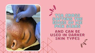 TCA CROSS SOFTENS THE EDGES OF ICE PICK SCARS AND CAN BE USED IN DARKER SKIN TYPES  DR JASON EMER [upl. by Funk]