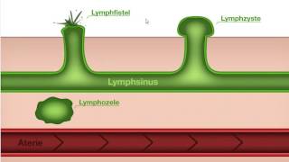 Ödemkomplikationen Manuelle Lymphdrainage [upl. by Orfinger]