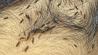 Real big lice removal from short hair satisfying [upl. by Jat]