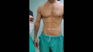 Lipoescultura Láser HD alta definición control a los 5 meseslipolaser lipohdhombre sixpacklaser [upl. by Namyl]