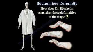 Boutonniere Deformity  Everything You Need To Know  Dr Nabil Ebraheim [upl. by Anwat]